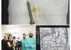 14 माह के बच्चे के पेट से 2.5 इंच की नुकीली स्क्रू एंडोस्कोपी से निकाली, सिटी सुपर स्पेशियलिटी हॉस्पिटल की टीम ने बचाई जान