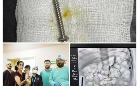 14 माह के बच्चे के पेट से 2.5 इंच की नुकीली स्क्रू एंडोस्कोपी से निकाली, सिटी सुपर स्पेशियलिटी हॉस्पिटल की टीम ने बचाई जान