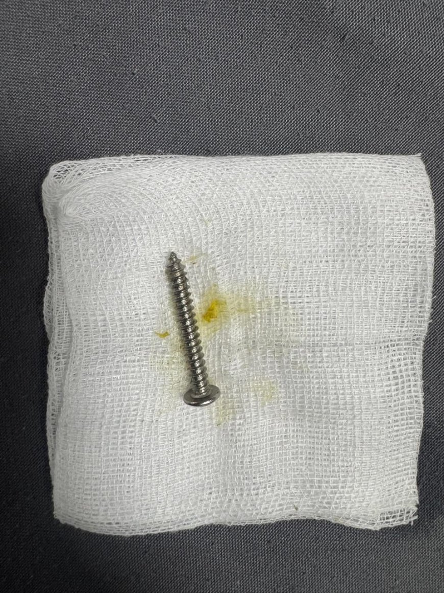 14 माह के बच्चे के पेट से 2.5 इंच की नुकीली स्क्रू एंडोस्कोपी से निकाली, सिटी सुपर स्पेशियलिटी हॉस्पिटल की टीम ने बचाई जान